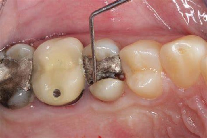 Can a broken molar be fixed