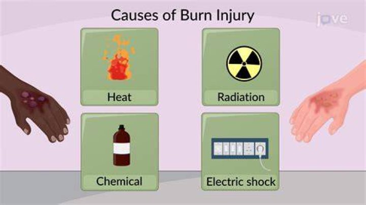 Can a major burn cause shock