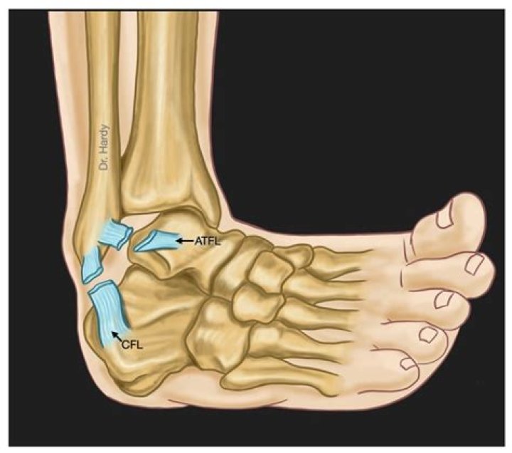 Can a torn ATFL heal itself