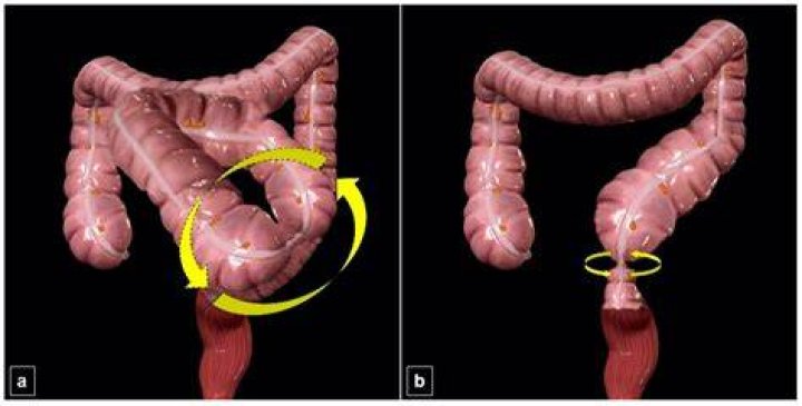 Can a twisted bowel be fixed
