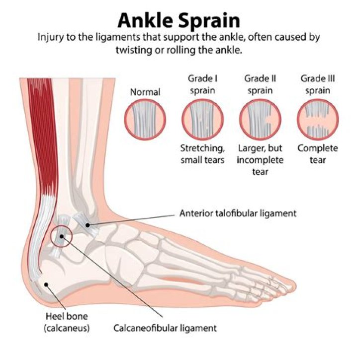 Can a UCL sprain heal itself
