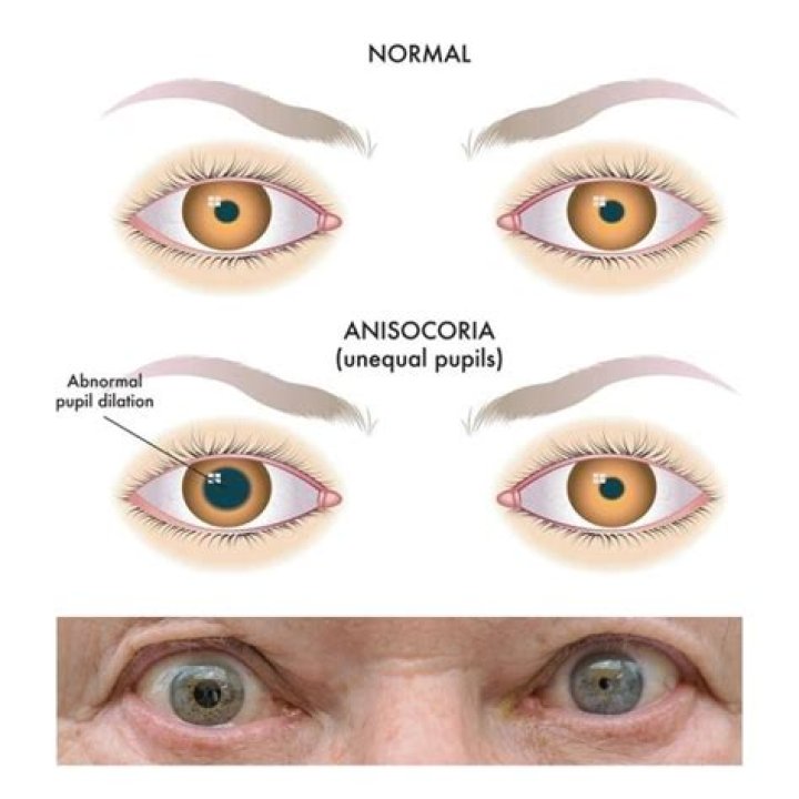 Can anisocoria be corrected