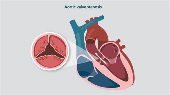 Can aortic stenosis be cured
