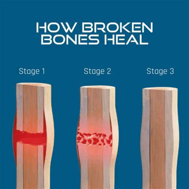 Can Arnica help broken bones