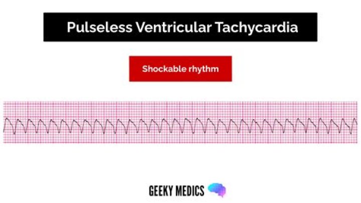 Can asystole be corrected