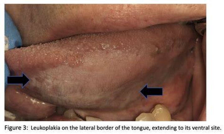 Can leukoplakia heal itself