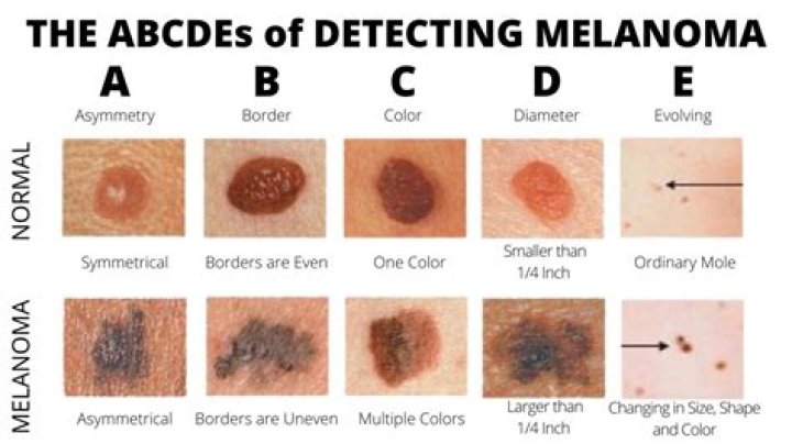 Can moles mess up foundation