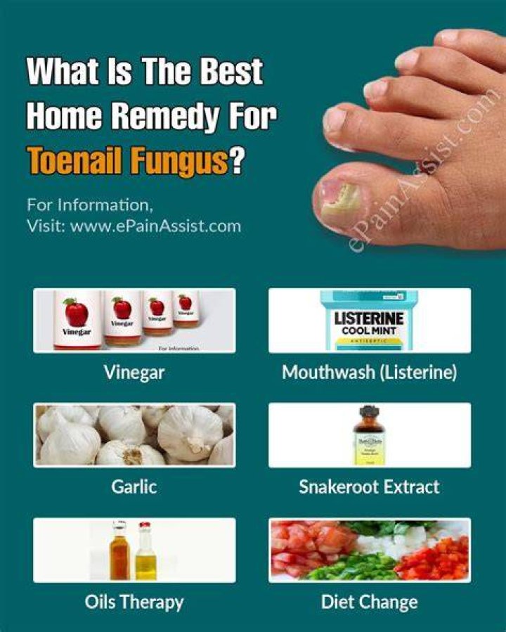 Can onychomycosis be treated