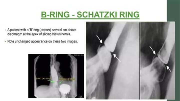 Can Schatzkis ring be cured