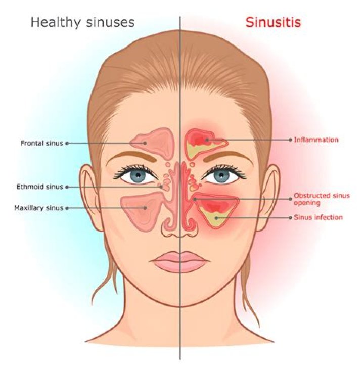 Can sinuses affect cavities