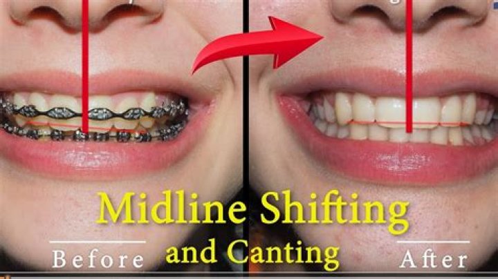 Can you fix a midline shift