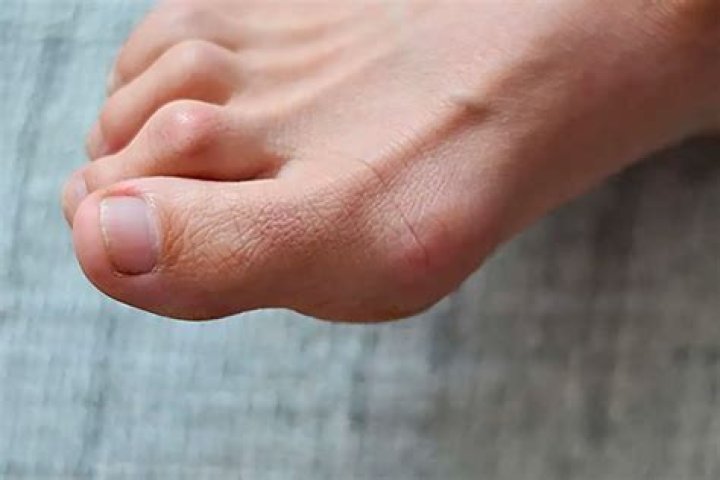 Can you reverse a hammer toe