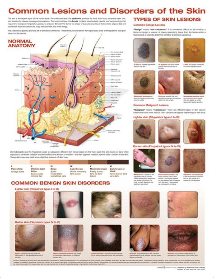 Do benign skin lesions bleed