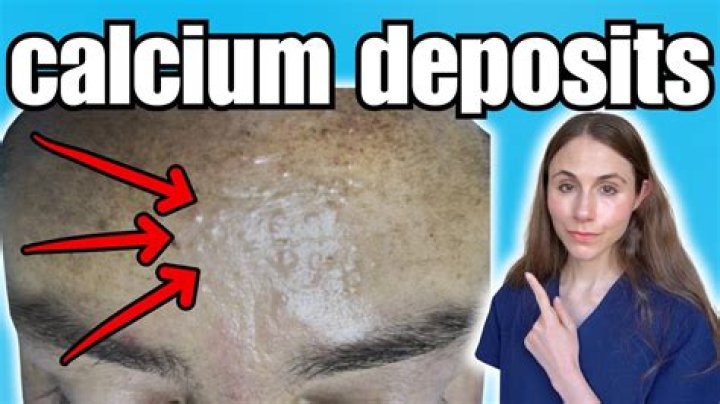 Do calcium deposits go away