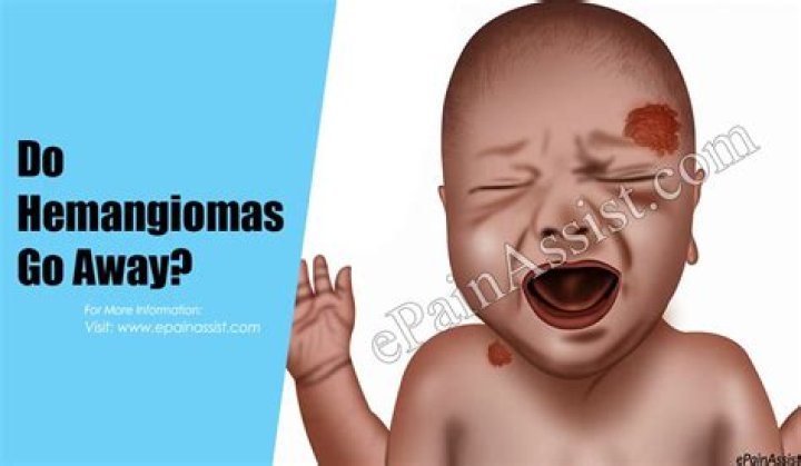 Do liver hemangiomas go away
