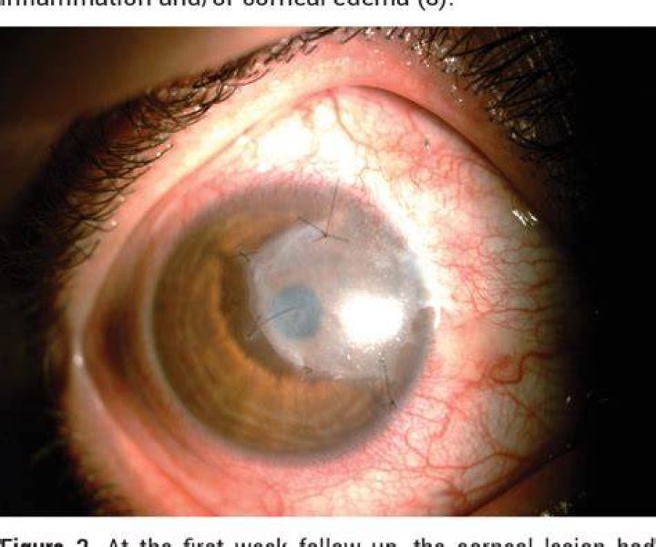 Does corneal pannus go away