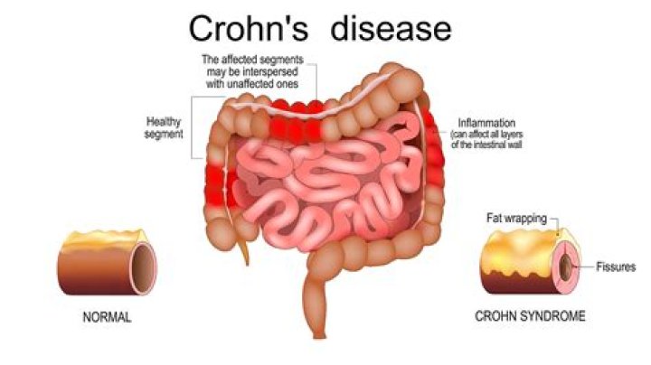 Does Crohns get misdiagnosed