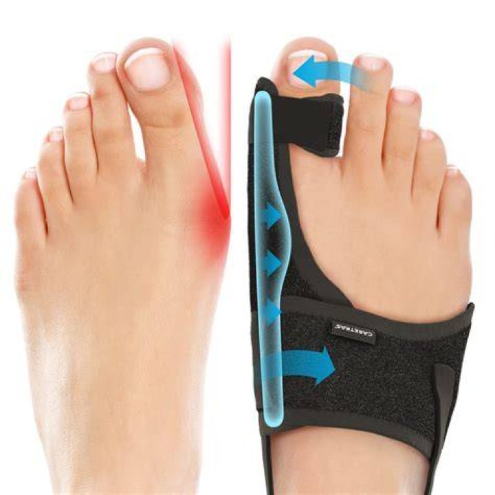 Does CVS sell bunion splints