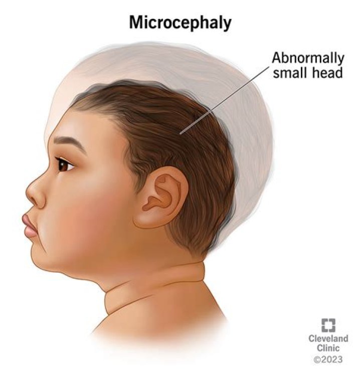Does dolichocephaly go away