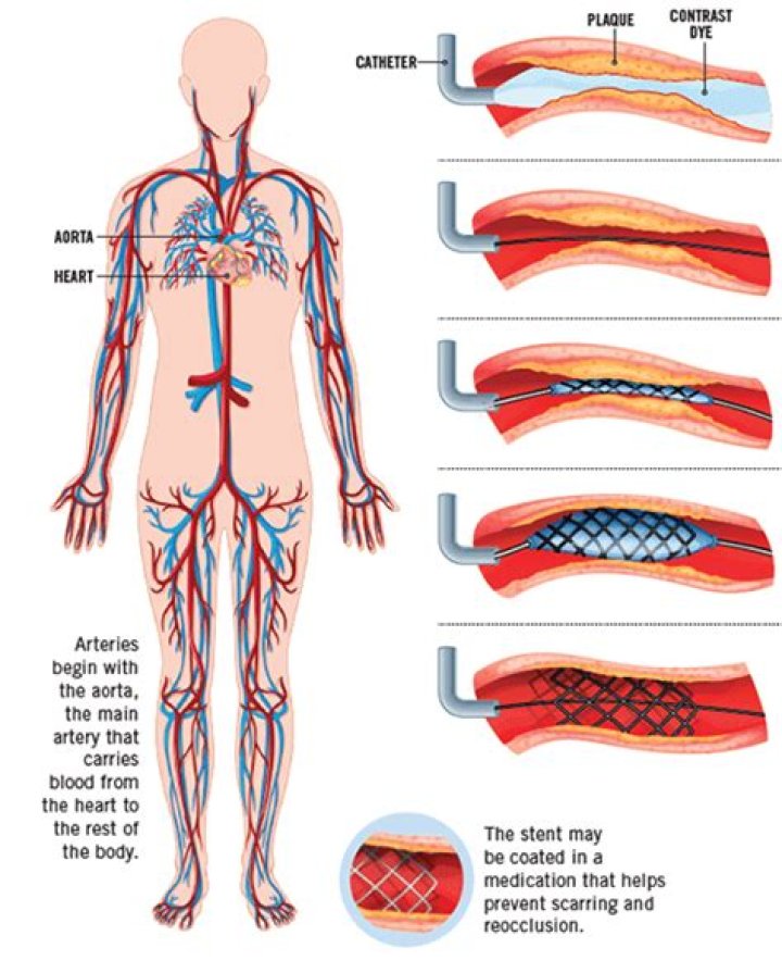Does meat clog your arteries