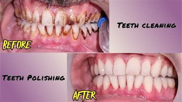 Does polishing damage teeth