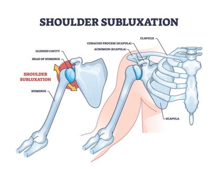 Does subluxation always hurt