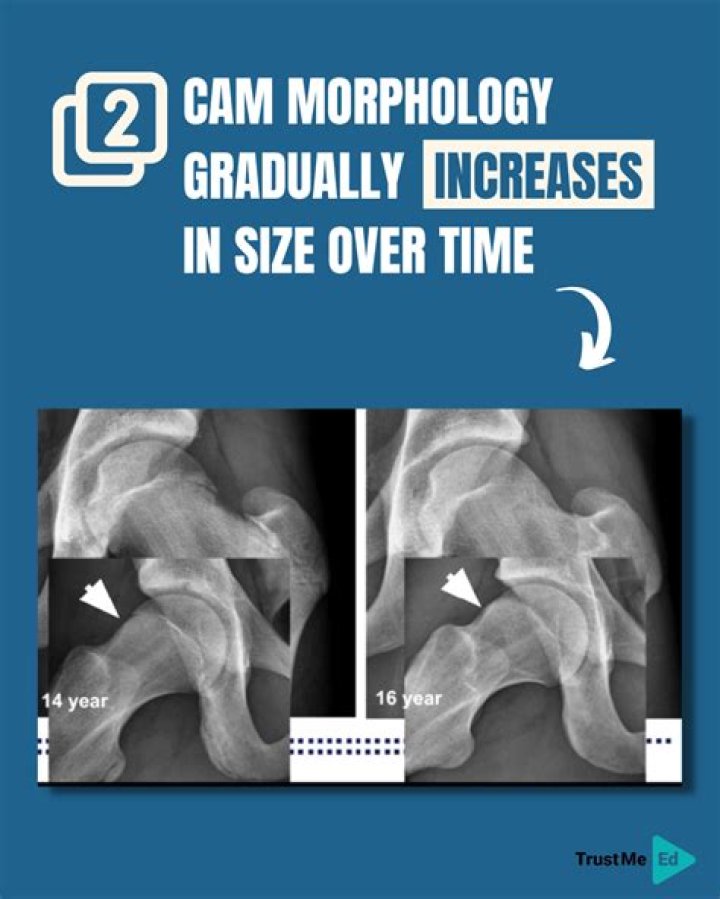 How common is Cam morphology