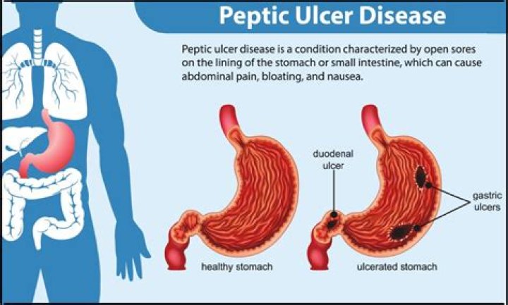 How do they fix a perforated ulcer