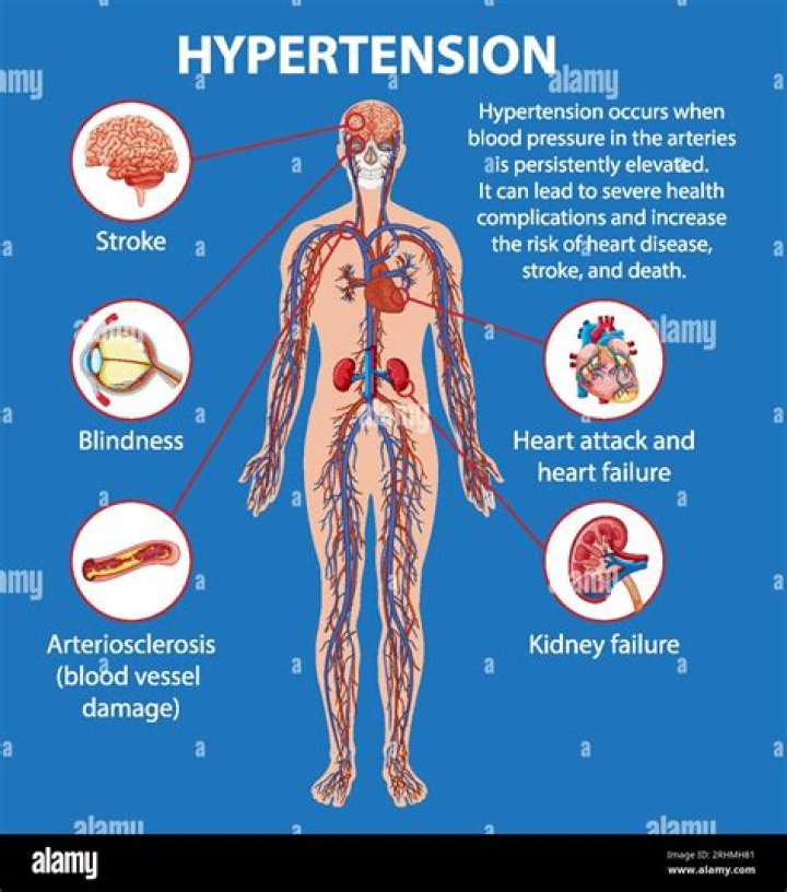How do you code hypertension