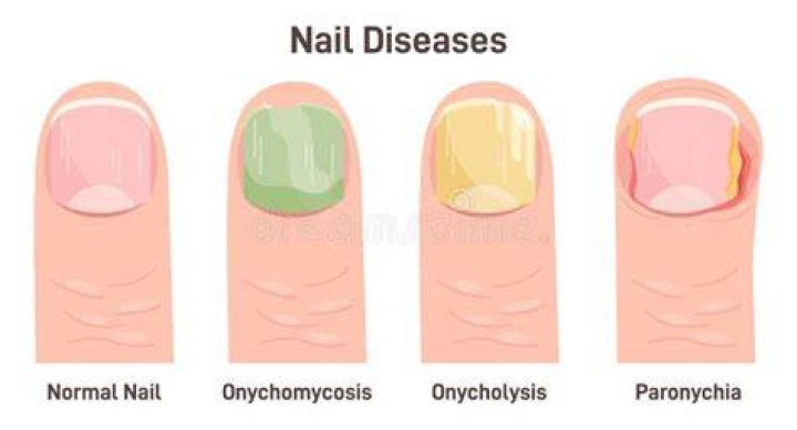 How do you fix onychoschizia