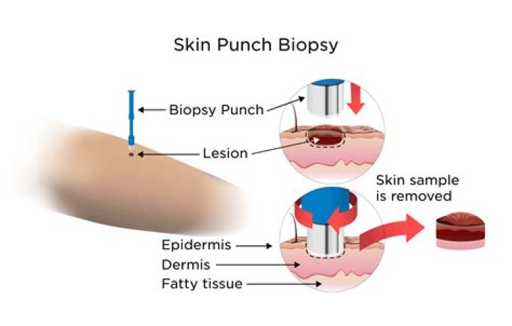 How does a dermal punch work