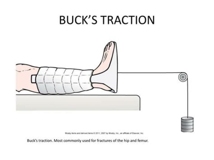 How does bucks traction work