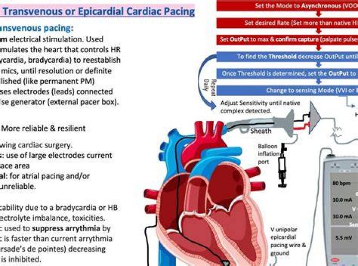 How does cardiac pacing work