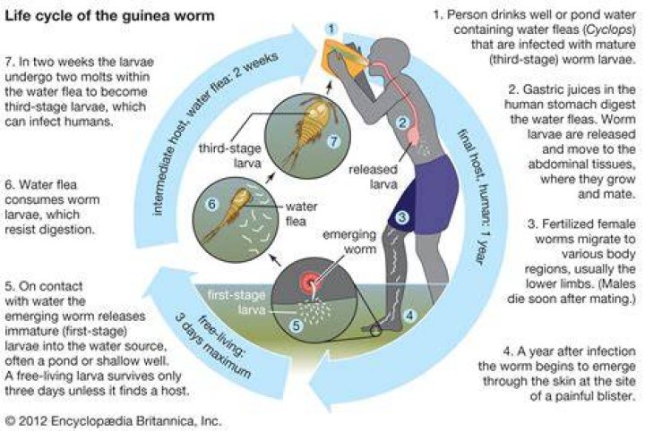 How is a guinea worm removed