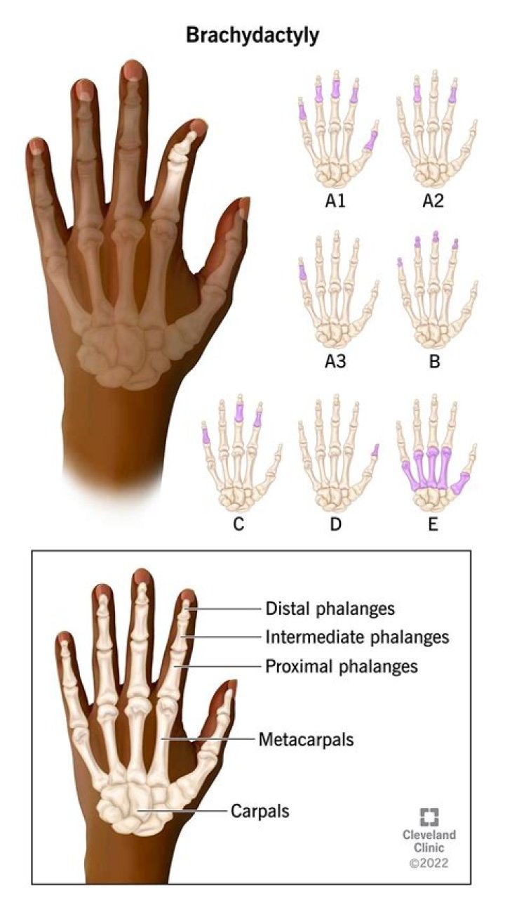 How is Brachydactyly treated