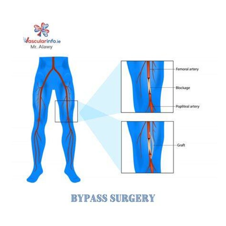 How is ETV surgery performed