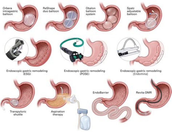 How is gastric analysis done