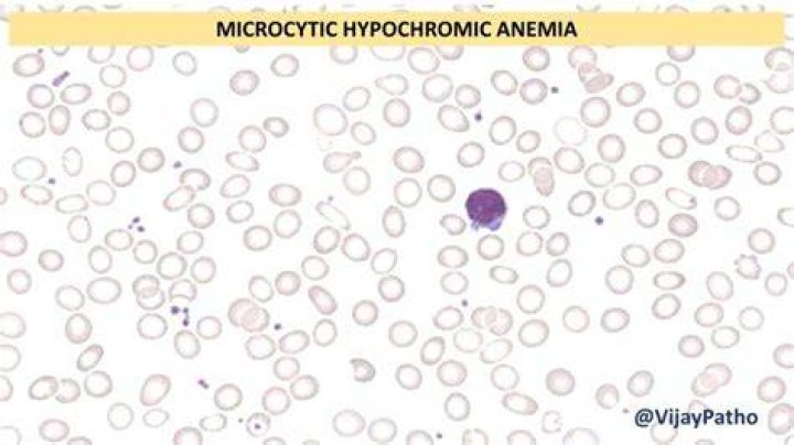 How is Microcytosis treated