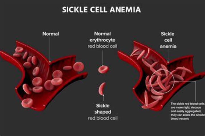 How is sickle cell anemia prevented