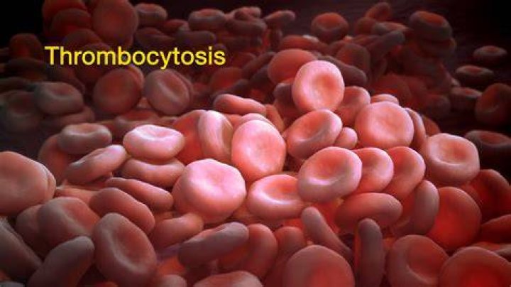 How is thrombocytosis diagnosed