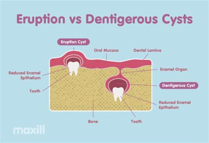 How long do eruption cysts last