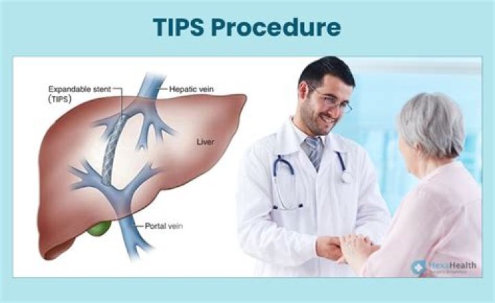 How long does a TIPS procedure take