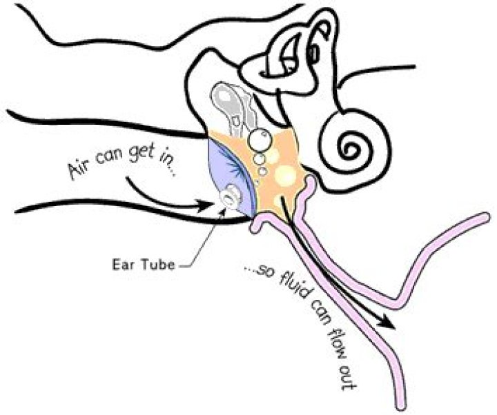 How tubes are placed in ears