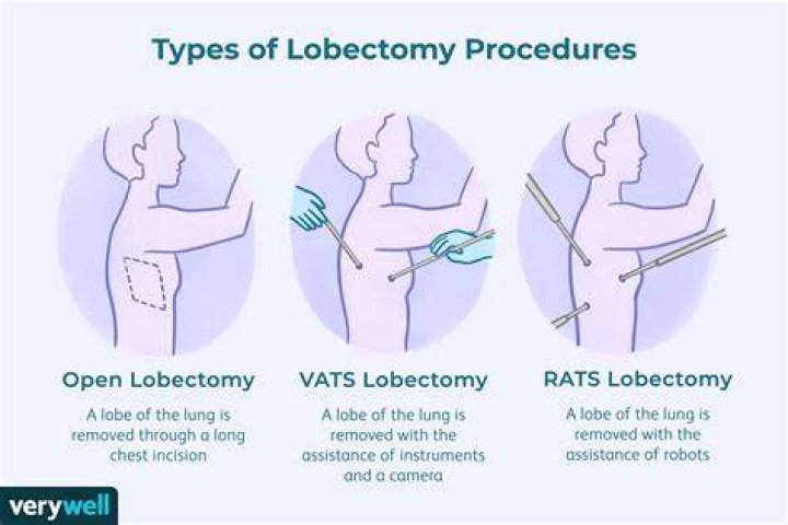 Is a lobectomy major surgery