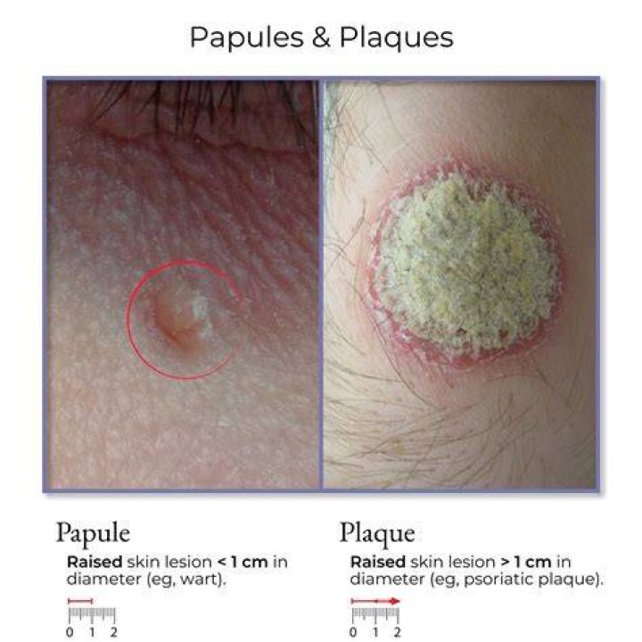 Is a papule a primary lesion