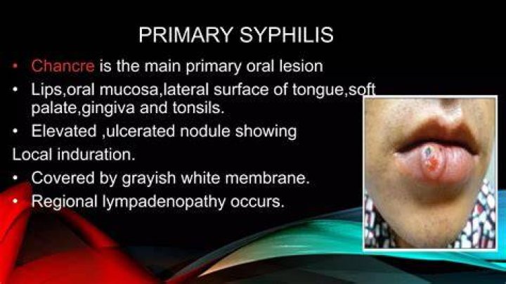 Is a syphilis chancre raised