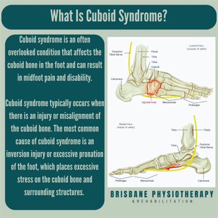 Is cuboid syndrome permanent