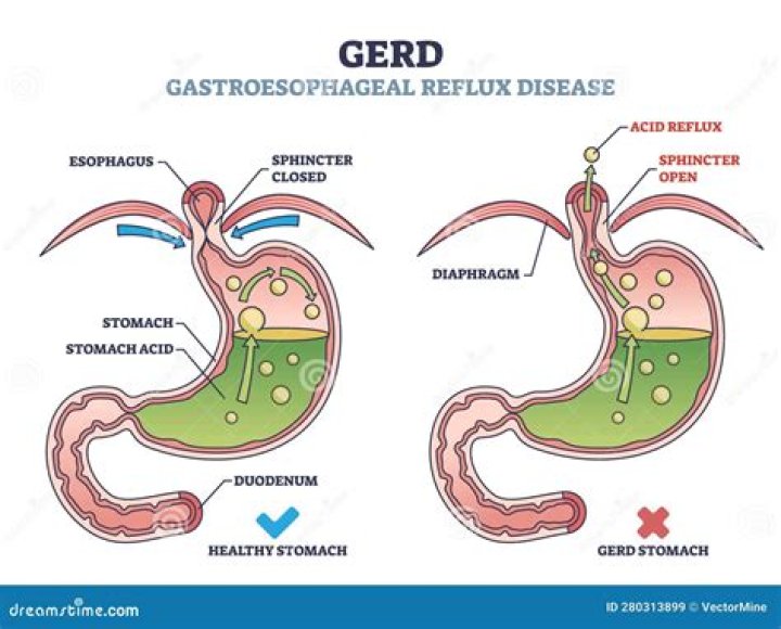 Is GERD and acid reflux same