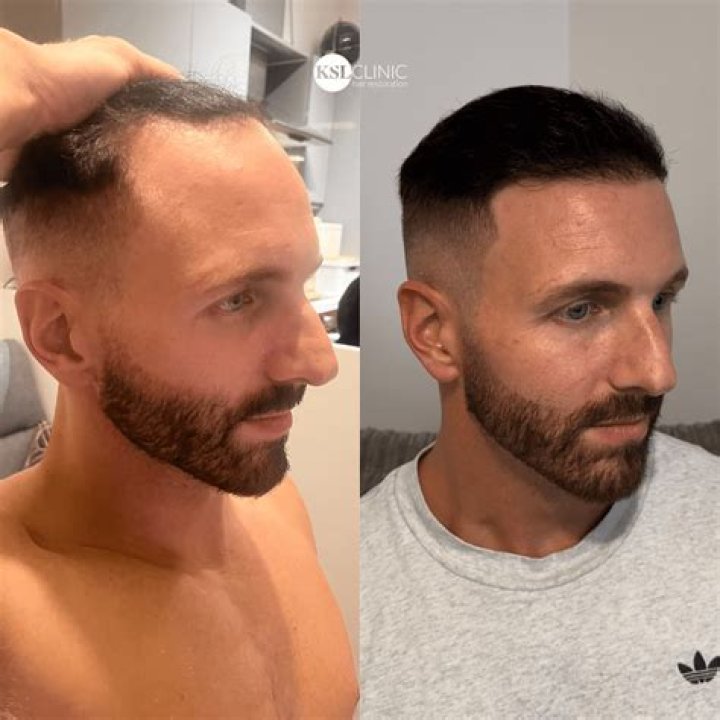 Is it normal to recede at 19
