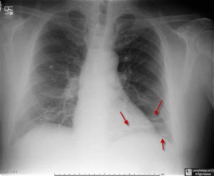 Is plate atelectasis serious